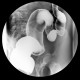 Ulcerative colitis, barium enema, irrigography: RF - Fluoroscopy